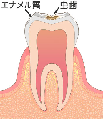 C1 エナメル質(歯の表面)の虫歯