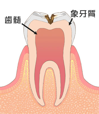C2 象牙質(神経に近い)の虫歯