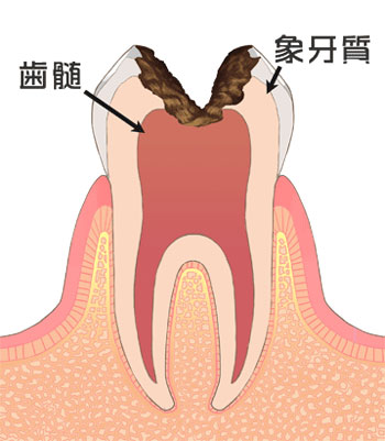 C3 歯根まで進んだ虫歯